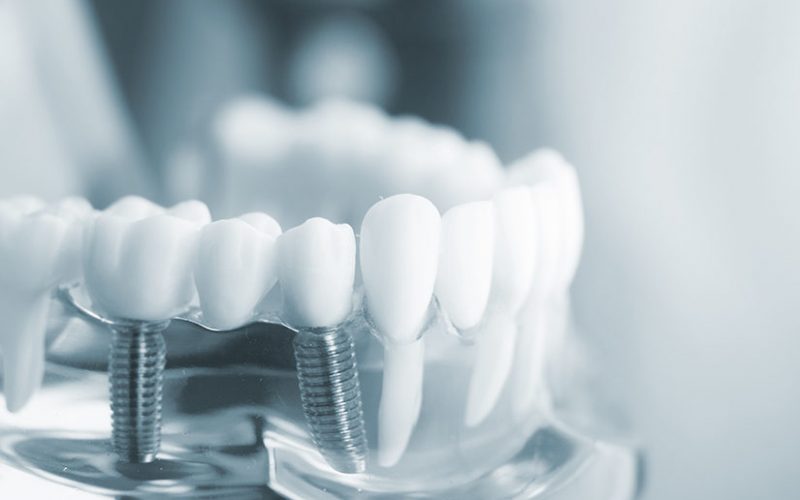 What Is The Difference Between Regular Dental Implants And Mini Implants
